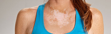 Understanding Vitiligo