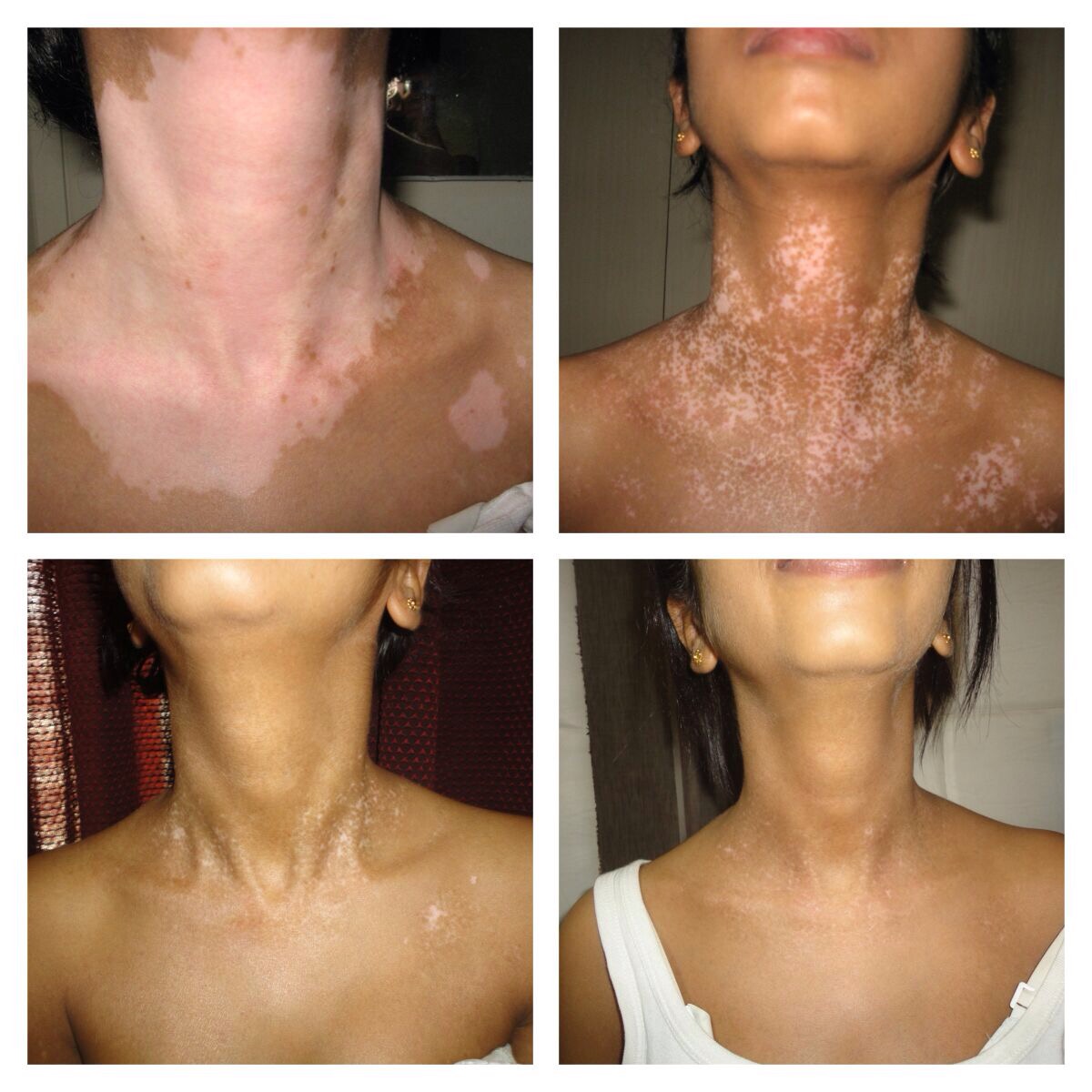 Case of Active Vitiligo