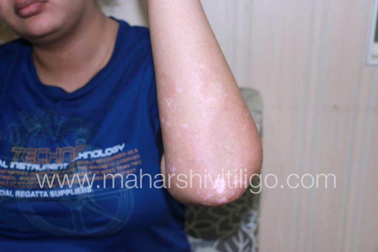 Changing her life and bringing her confidence back, white patch patient from Delhi