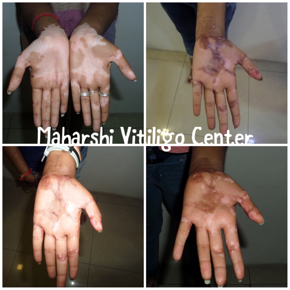It very true that hard work and patience pays, we are very happy to share Melanocyte Transplant results over Palmer Aspect of hand on our Mumbai Vitiligo patient.