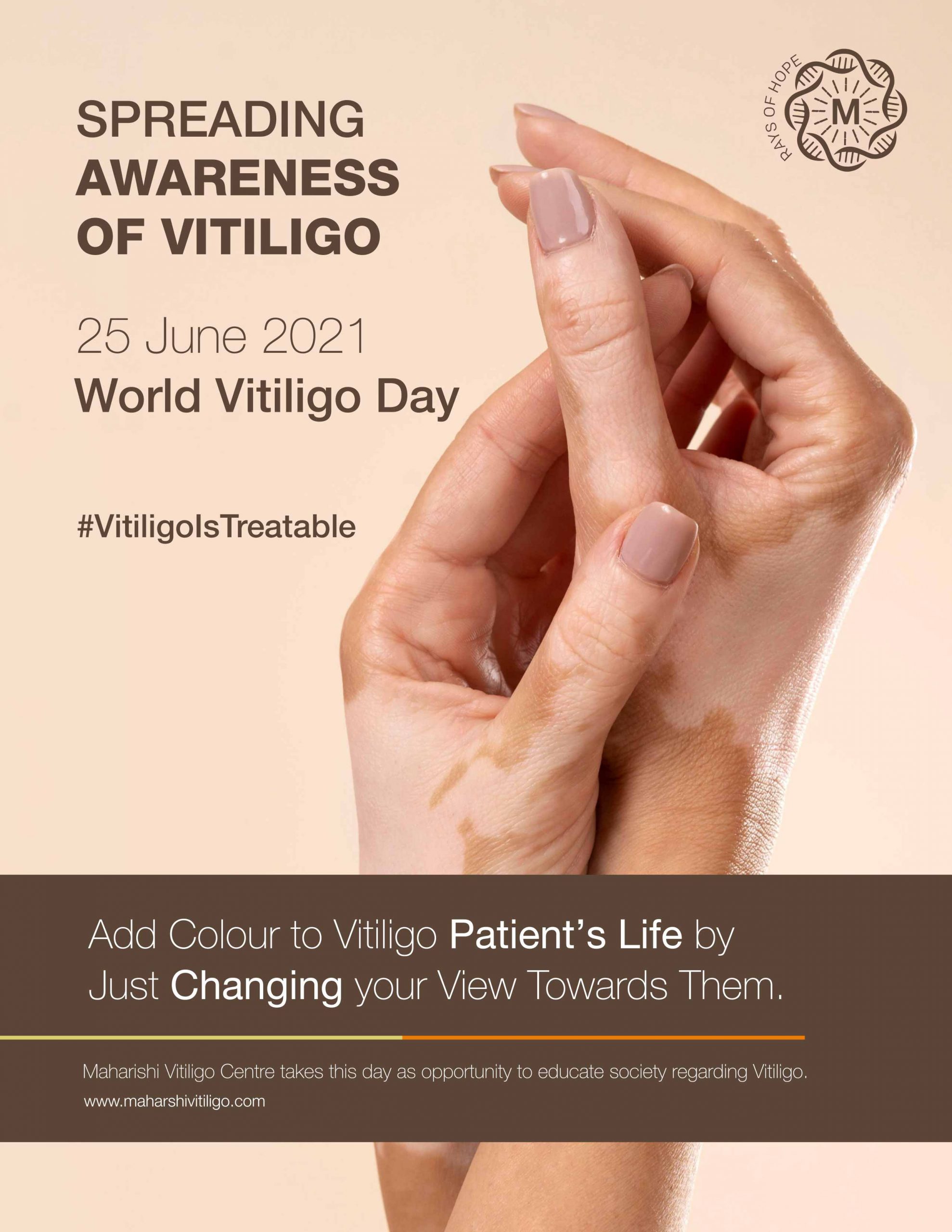 Spreading Awareness of Vitiligo on – World Vitiligo Day 2021