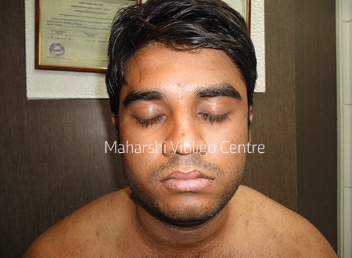 Vitiligo Centre Indore - After