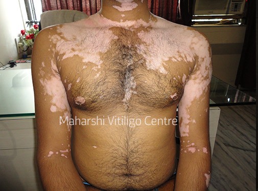 Vitiligo Centre Indore - Before