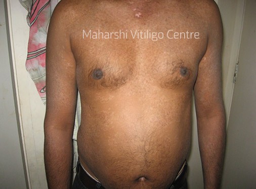 Vitiligo Centre Indore - After