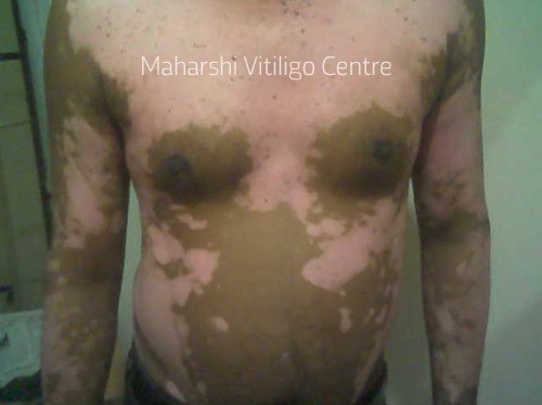 Vitiligo Centre Indore - Before
