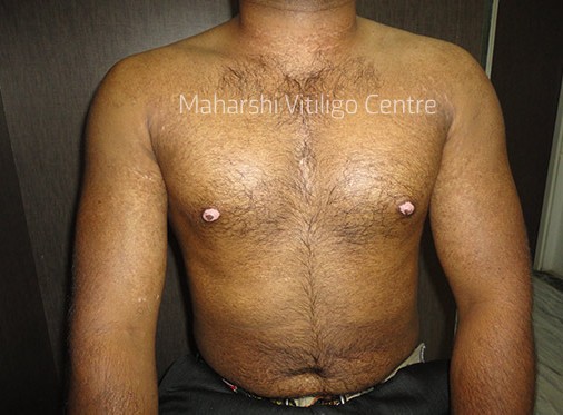 Vitiligo Centre Indore - After
