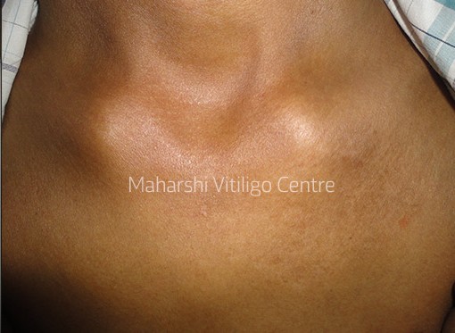 Vitiligo Centre Indore - After