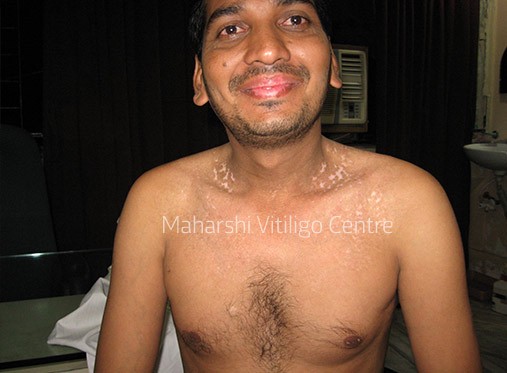 Vitiligo Centre Indore - After