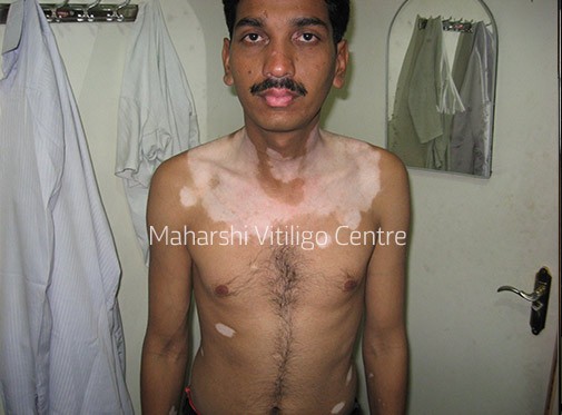 Vitiligo Centre Indore - Before