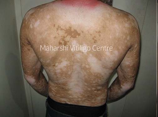 Vitiligo Centre Indore - Before