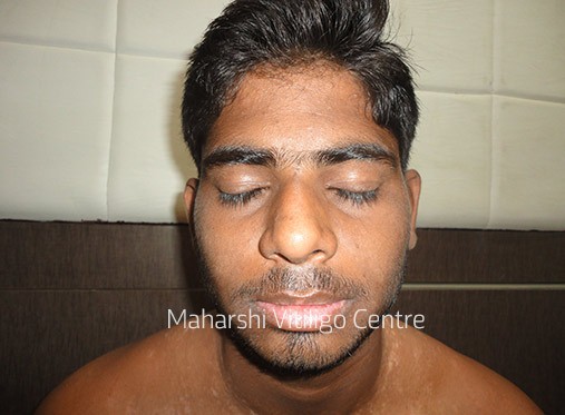 Vitiligo Centre Indore - After