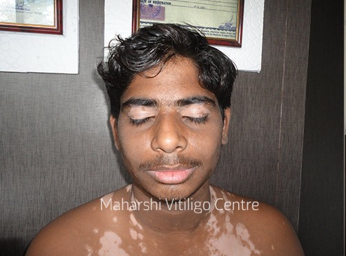Vitiligo Centre Indore - Before