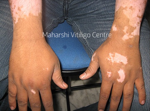 Vitiligo Centre Indore - Before