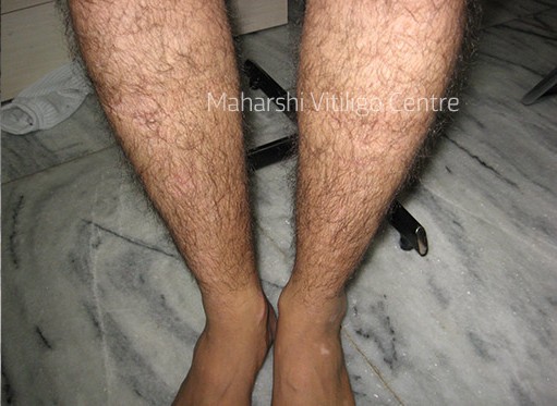 Vitiligo Centre Indore - After