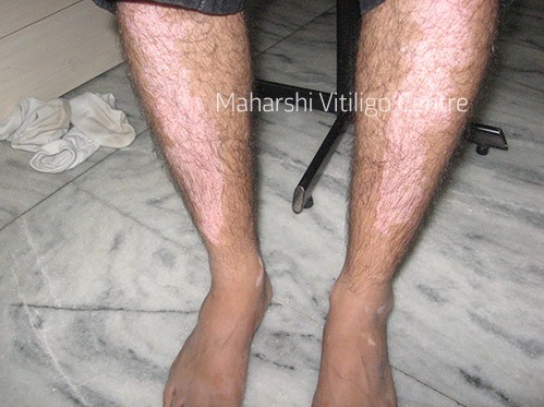 Vitiligo Centre Indore - Before