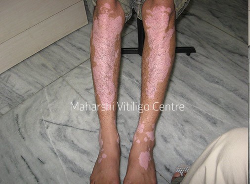 Vitiligo Centre Indore - Before