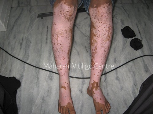 Vitiligo Centre Indore - Before