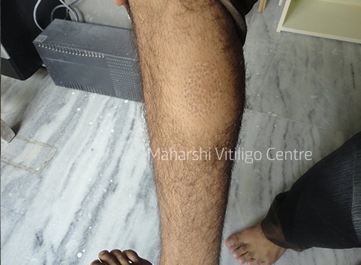 Vitiligo Centre Indore - After