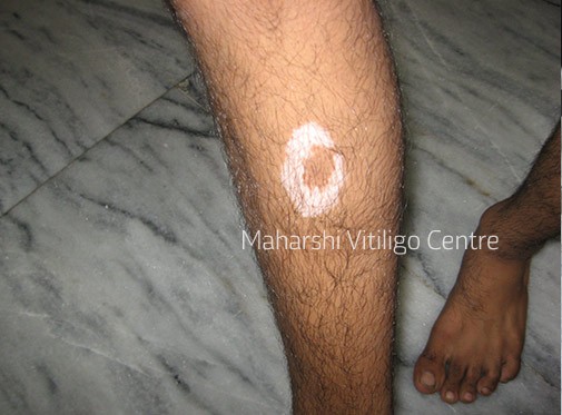 Vitiligo Centre Indore - Before