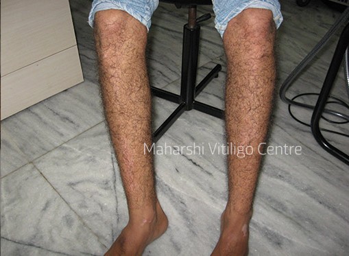 Vitiligo Centre Indore - After