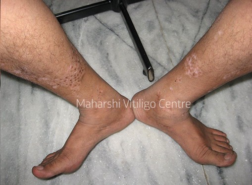 Vitiligo Centre Indore - After