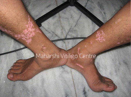 Vitiligo Centre Indore - Before