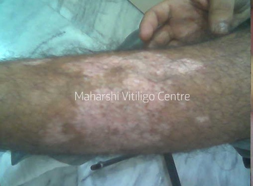 Vitiligo Centre Indore - Before