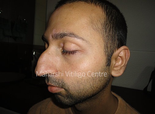 Vitiligo Centre Indore - After