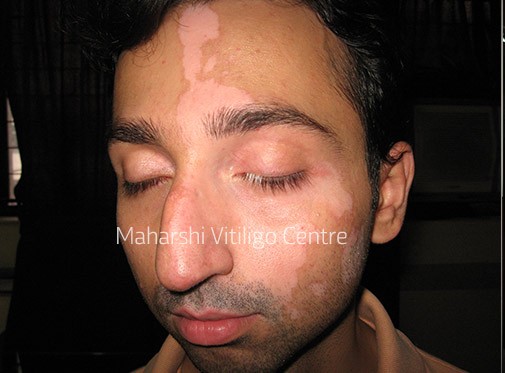 Vitiligo Centre Indore - Before