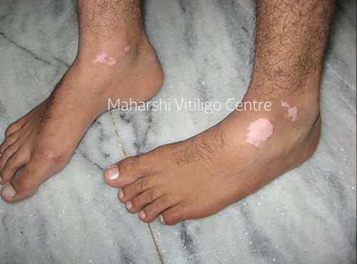 Vitiligo Centre Indore - Before