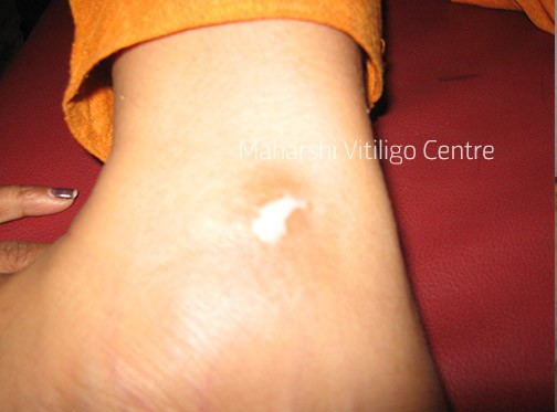 Vitiligo Centre Indore - Before