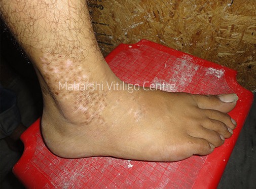 Vitiligo Centre Indore - After