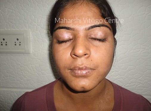 Vitiligo Centre Indore - After