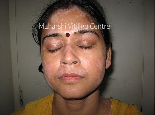 Vitiligo Centre Indore - Before