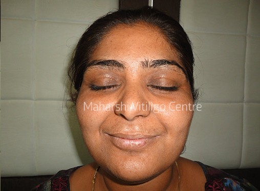 Vitiligo Centre Indore - After