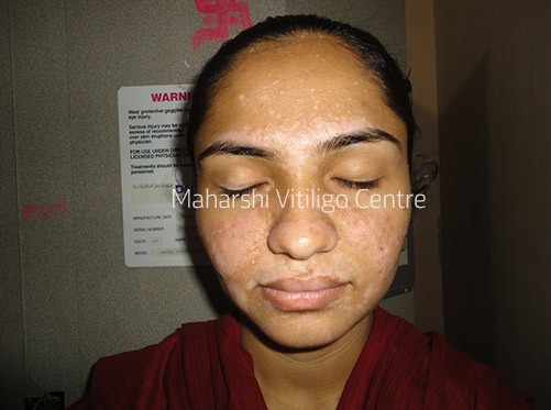 Vitiligo Centre Indore - Before