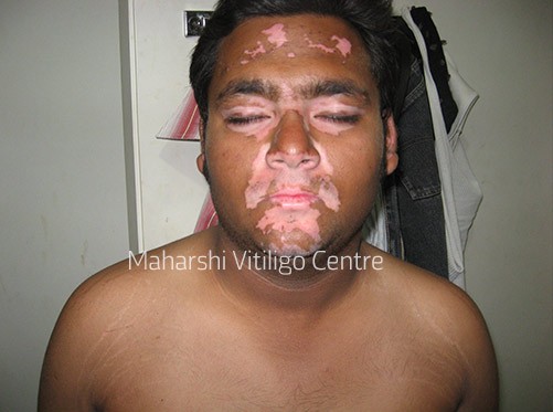 Vitiligo Centre Indore - Before