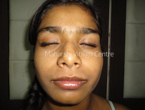 Vitiligo Centre Indore - After