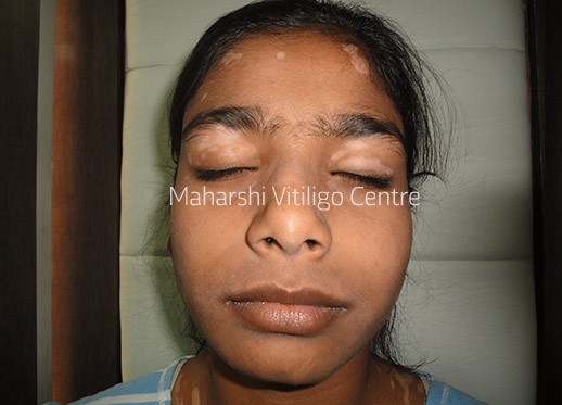 Vitiligo Centre Indore - Before