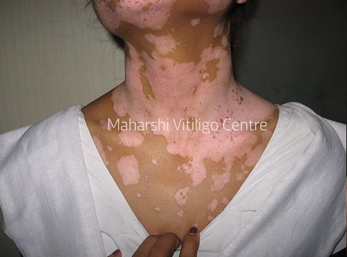 Vitiligo Centre Indore - Before