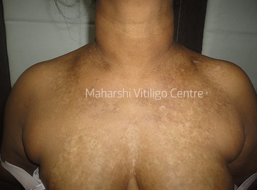Vitiligo Centre Indore - After