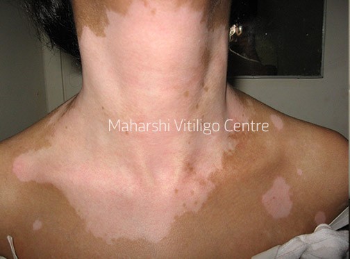 Vitiligo Centre Indore - Before