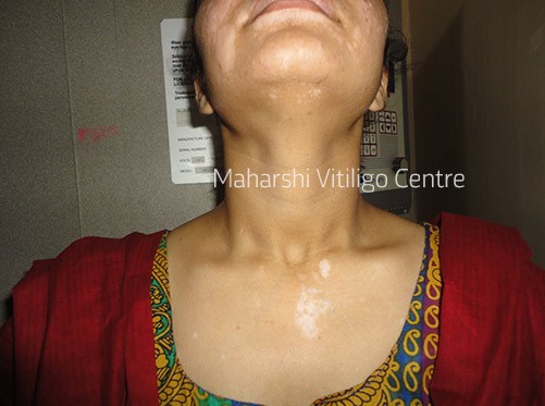 Vitiligo Centre Indore - Before