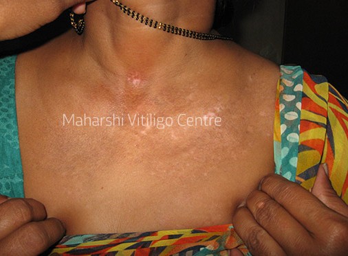 Vitiligo Centre Indore - After