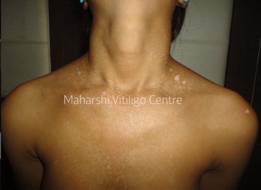 Vitiligo Centre Indore - After