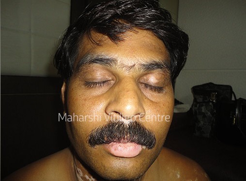 Vitiligo Centre Indore - After