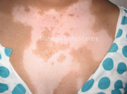 Vitiligo Centre Indore - Before