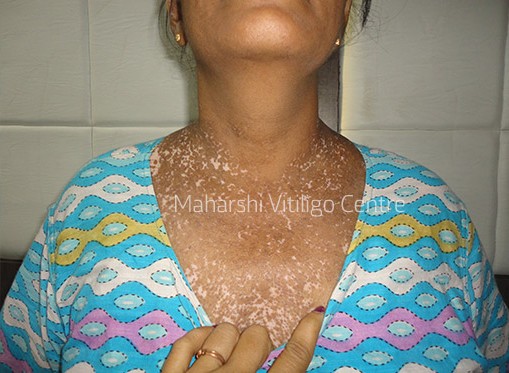 Vitiligo Centre Indore - After