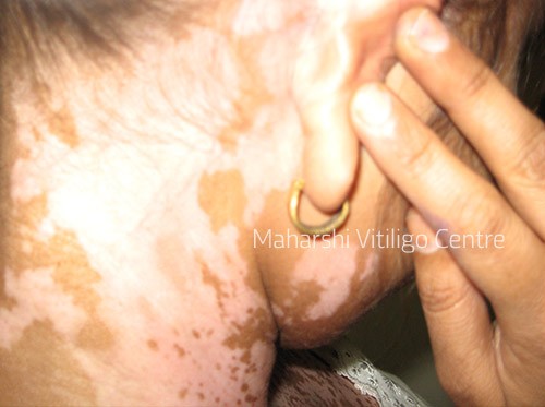 Vitiligo Centre Indore - Before