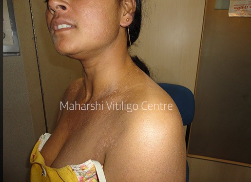 Vitiligo Centre Indore - After